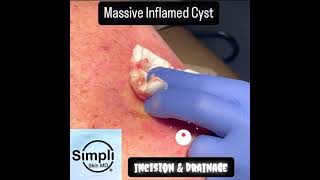 Massive Inflamed Cyst Incision amp Drainage [upl. by Itaws]