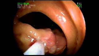 Using Capsule Endoscopy and Double Balloon Enteroscopy for Complex Small Intestinal Disease [upl. by Anilah]