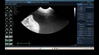 IQ 309 ASCITES BLOOD LYMPHOMA ULTRASOUND [upl. by Janela]