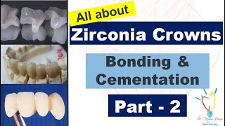 Zirconia Crowns  CEMENTATION vs BONDING [upl. by Pritchard172]