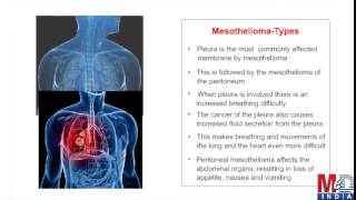 MesotheliomaA Rare Lung Cancer [upl. by Roose]