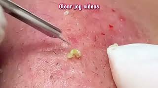 Big Cystic Acne Blackheads ExtractionBlackheads amp Milia Whiteheads Removal Pimple Popping [upl. by Idonah]