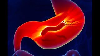 Helicobacter Pylori causa más del 50 de casos de gastritis en Latinoamérica [upl. by Eseekram]