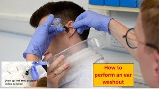 How to Perform an Ear Washout irrigation  ENTOtolaryngology Skills [upl. by Whelan]