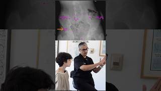 9 Years Limping and SEVERE Back Pain  Coccyx amp Pelvis Adjustment shorts [upl. by Ole]