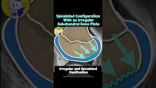 Fig 5B27 Types of Ossification Variants of the Knee [upl. by Ariaes]