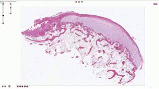 Ostechondroma  Histopathology [upl. by Annabela]