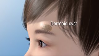 Dermoid Cyst Ablation [upl. by Ainit]