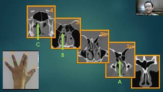 Paranasal Sinuses CT  A map toward safe endoscopic sinus surgery [upl. by Torrey]