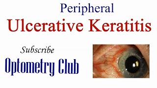 Peripheral Ulcerative Keratitis Introduction Systemic Symptoms Clinical Features and Treatment [upl. by Springer21]