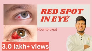 Blood spot in eye reasons How to treat blood spot in eye  Subconjunctival haemorrhage [upl. by Cori]