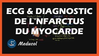 ECG et diagnostic de linfarctus du myocarde crise cardiaque [upl. by Dreddy]