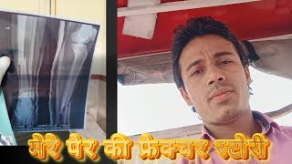 Fracture Story Of my tibia Fibula SurvivalWithNitin jharaayurveda0007 ChirayuHospital vlog [upl. by Etteraj]