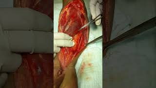 antomy of forearm of pt during fasciotomy [upl. by Ahc903]