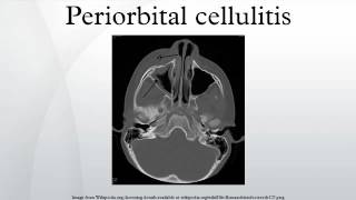 Periorbital cellulitis [upl. by Rotow]