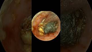 COMPLETE Package Of Earwax With Fungi [upl. by Pallua875]