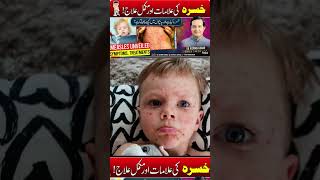 Measles Understanding Symptoms and Top Treatments measles treatment khasra [upl. by Greiner]