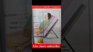 Continuous bladder irrigation  study on medical vijay education and news shortsvideo urologic [upl. by Namrehs]