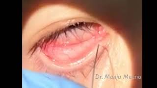 Lacrimal Syringing [upl. by Eimma659]