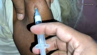 Arms injection video Im Triamcinolone Acetonide  Alfacort  injection push 24 P07 [upl. by Annohsak]