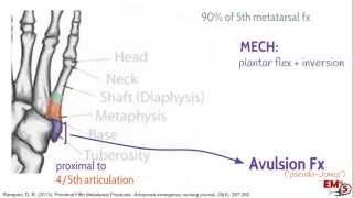 5th Metatarsal Fractures [upl. by Nila250]