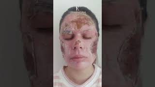 Peeling de Fenol para cicatrizes de acne [upl. by Atiekan]