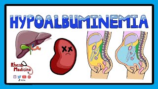 Hypoalbuminemia  Functions of Albumin in the Body  Pathophysiology of Hypoalbuminemia [upl. by Ilene]