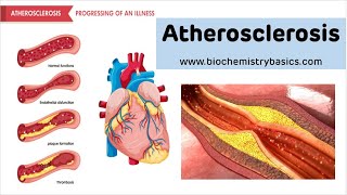 Atherosclerosis  Risk factors Pathophysiology and Prevention [upl. by Neelyk695]