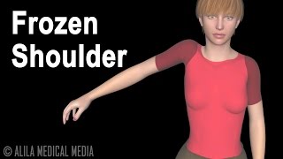 Frozen Shoulder Adhesive Capsulitis Animation [upl. by Uhn]