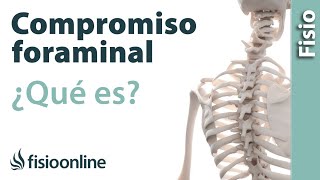 Compromiso foraminal o del neuroforamen  ¿Qué es [upl. by Rot589]