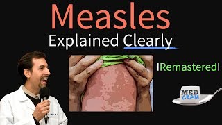 Measles Symptoms Diagnosis Vaccine Treatment Explained [upl. by Allistir]