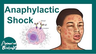 Anaphylactic shock  Anaphylactic Reaction Symptoms and Treatment [upl. by Salomo]