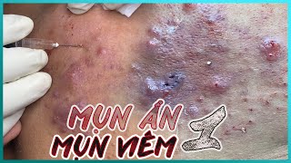 Big Cystic Acne Blackheads Extraction Blackheads amp Milia Whiteheads Removal Pimple Popping [upl. by Burdelle374]