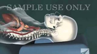 Cervical Chiropractic Adjustment [upl. by Melitta]