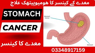 Stomach Cancer Symptoms amp Miasmatic Treatment in Homeopathy stomachcancer hpylori [upl. by Gabbey]