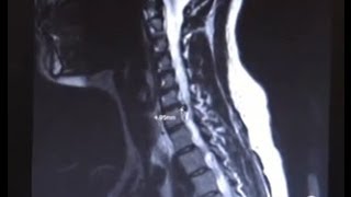 Cervical Spine Fusion with Neurosurgeon Dr Alok Chaudhari [upl. by Maureene112]