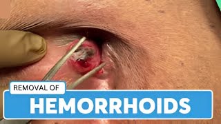 Hemorrhoids Helpful Solutions [upl. by Augustine510]