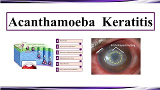 Acanthamoeba Keratitis [upl. by Eilsew566]