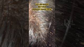 Lice treatment Chennaihow to remove lice from hairanti lice removallice removalhow to treat lice [upl. by Sherris55]