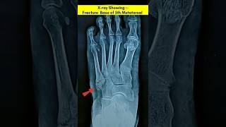 Fracture Metatarsal bone of Foot ⚡️Radiographerusn xray fracture [upl. by Crawford]