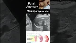 Fetal Meningomyelocele Insights into Diagnosis and Care case fetalanomaly shorts DrSaimakhan [upl. by Yatnoed]