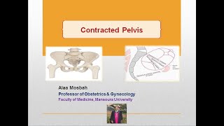 Contracted Pelvis [upl. by Ilagam]