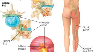 Reasons of tingling and numbness of the legs associated with back pain [upl. by Elbart]