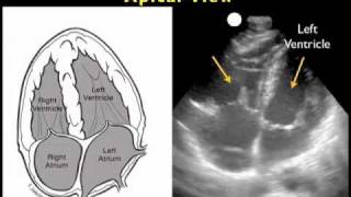 How to Cardiac Ultrasound  Apical View Case Study [upl. by Nytsrik820]