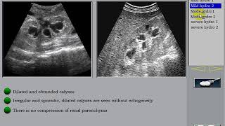 Ultrasound of the kidney 6 Hydronephrosis [upl. by Anayrb]