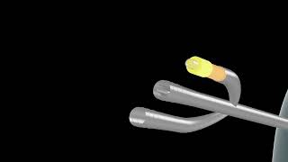 3D Animated Video Explaining 3way Foley catheter with an inflow port [upl. by Alodie]