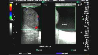 Ultrasound video Hydrocele and epididymal cyst [upl. by Obeded]