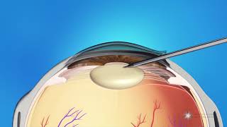 Phacoemulsification Cataract Surgery [upl. by Chill]