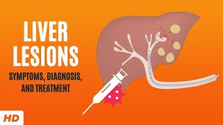 Liver Lesions Symptoms Diagnosis and Treatment [upl. by Lillian]