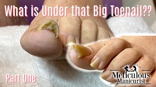 Ingrown Toenail and Impacted Toenail Relief and PreventionMrMeticulousMarathon [upl. by Anibas864]